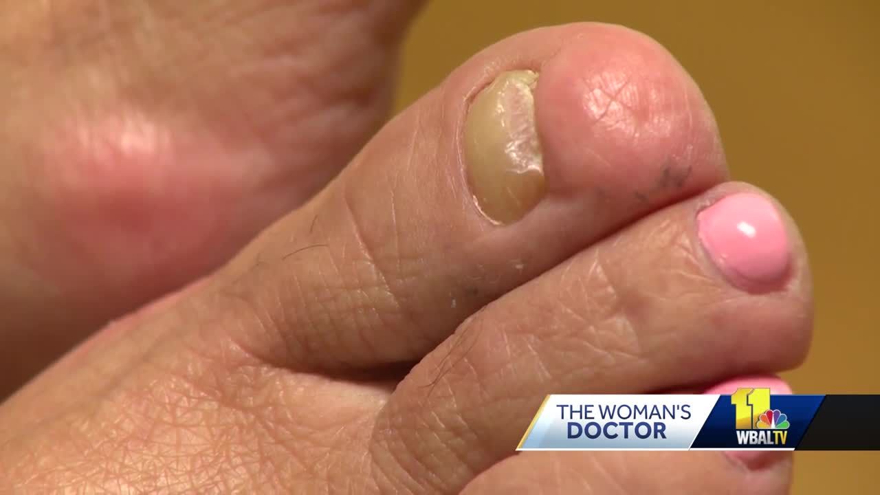 Toenail Fungus Treatment – What are my options? — FOOT & ANKLE CENTERS