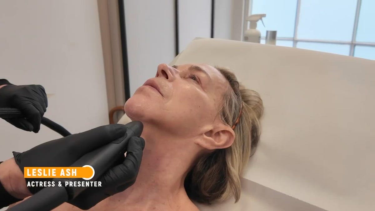 leslie ash 10 years younger facelift