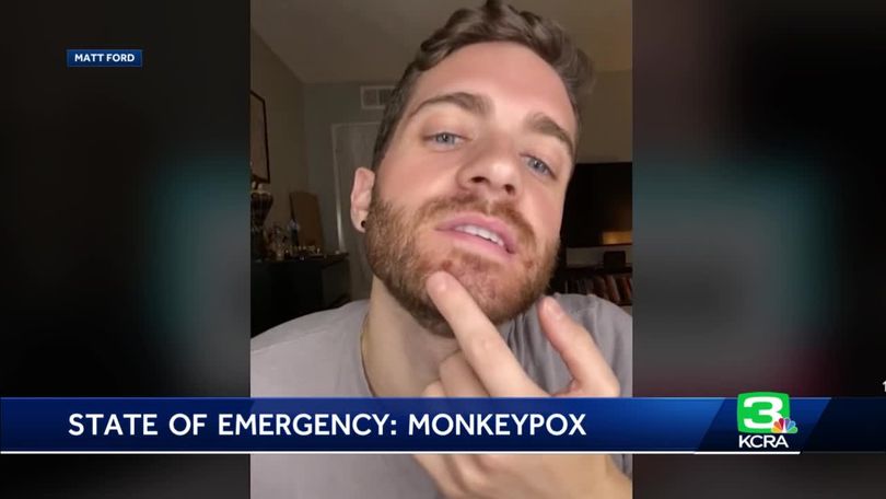 California Man Details Monkeypox Experience