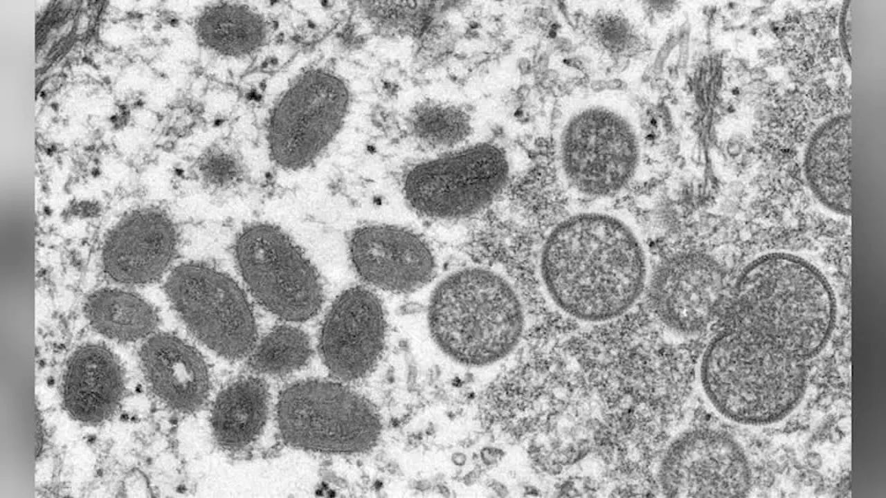 'This is highly unusual;' CDC asks health officials to look for monkeypox