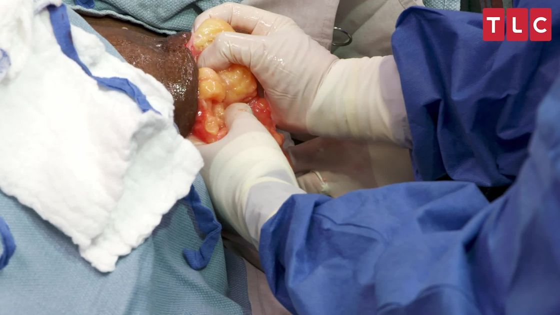 preview for Dr. Pimple Popper Pulls Gigantic Lipoma From Patient's Hip