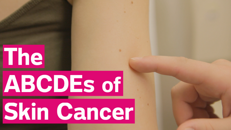 preview for ABCDEs Of Skin Cancer