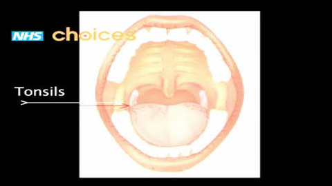 Tonsillitis Symptoms Signs And Treatment