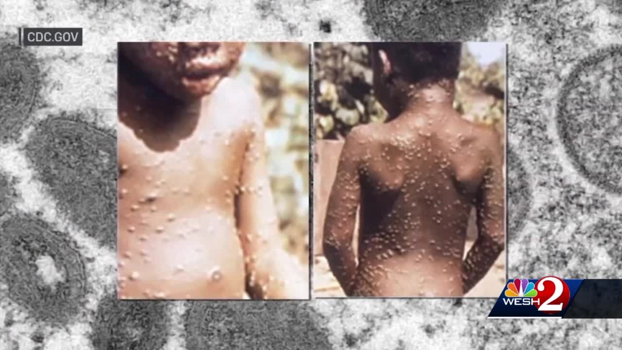First possible monkeypox case in Florida