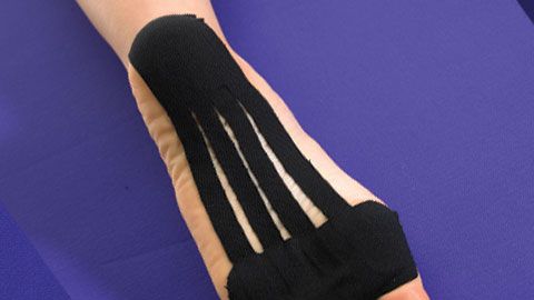 preview for Plantar Fasciitis Treatment Using Kinesio Tape