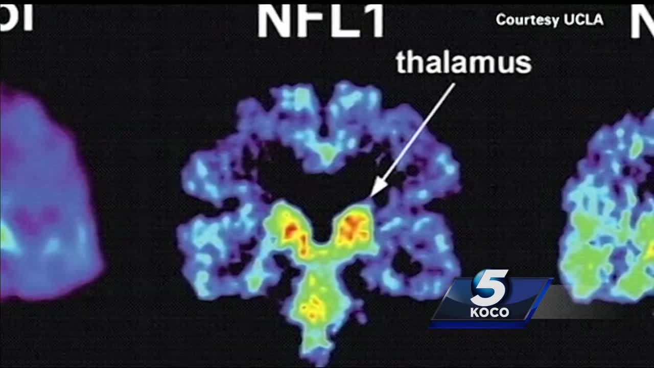 Football, CTE, and Dementia: 5 New Answers, The Brink