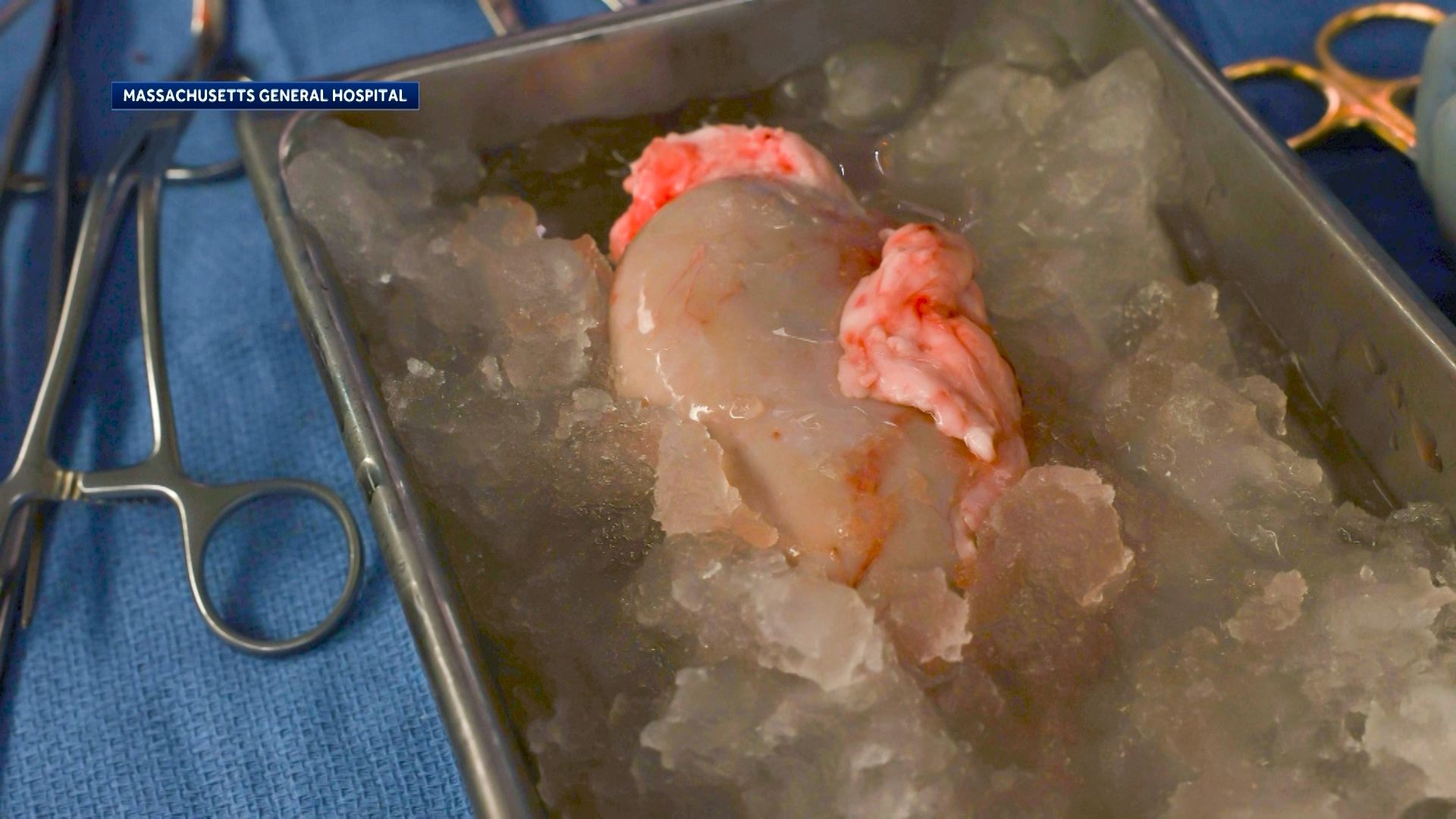 First successful pig-to-human kidney transplant raises ethical questions