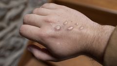 Monkeypox: How It Affects the Eyes and What You Can Do