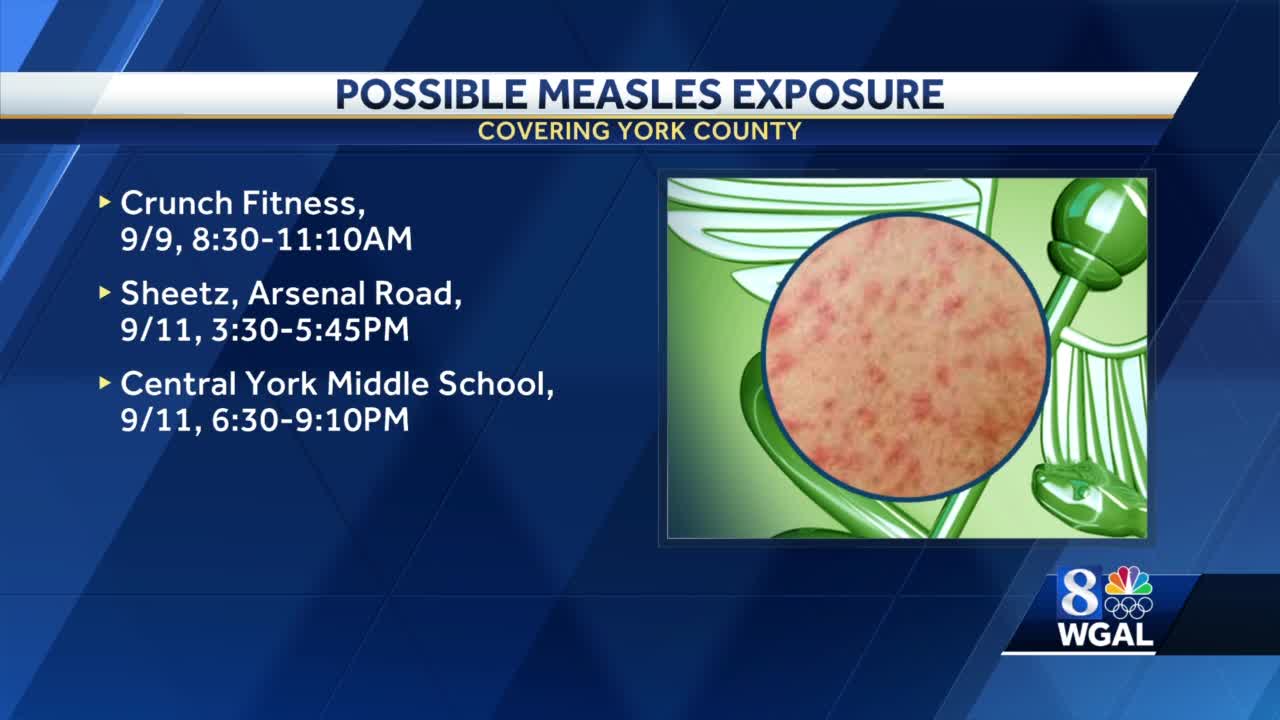 Second Case Of Suspected Measles Possible Exposure In Several