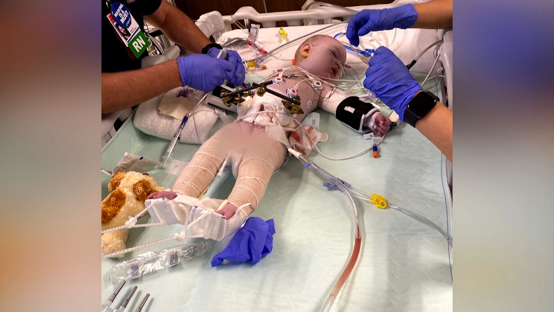 Baby has surgery to move bladder inside his body