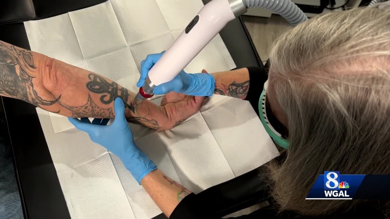 Tattoo Removal with Q-Switch Laser. 5th Session. Our patient requested that  the arrow should be visible only. — Please contact us via… | Instagram