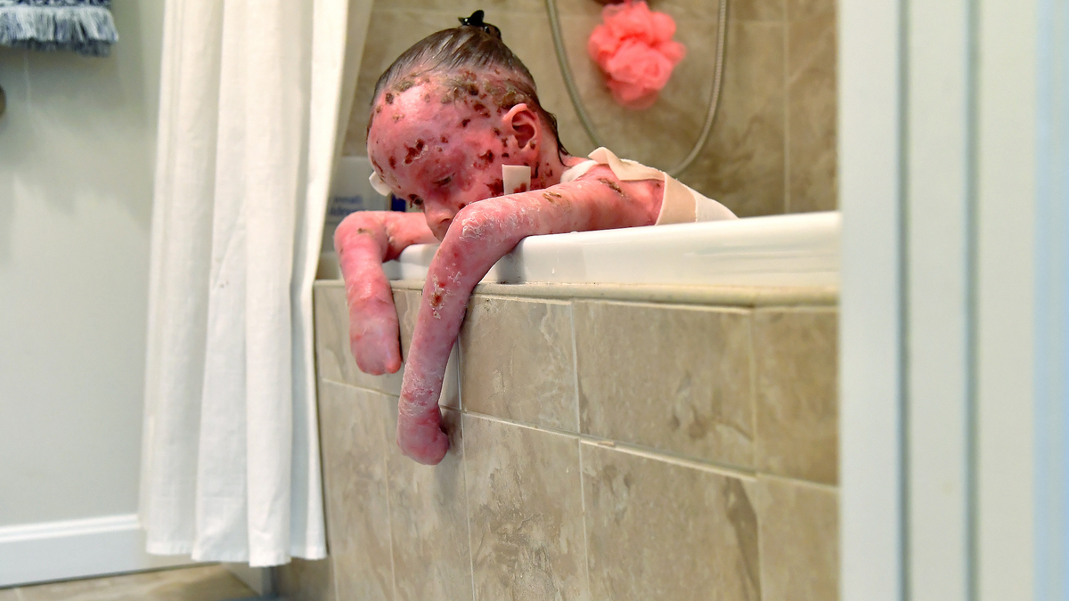 Epidermolysis Bullosa
