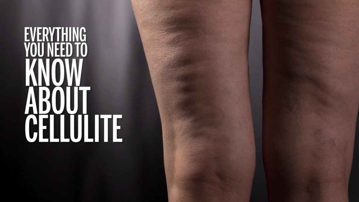 preview for Everything You Need to Know About Cellulite