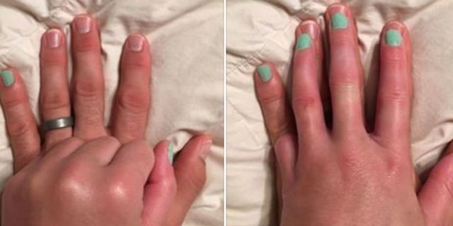 Husband Paints His Pinky Nail - Husband Helps His Wife Feel Better About  Losing Her Pinky