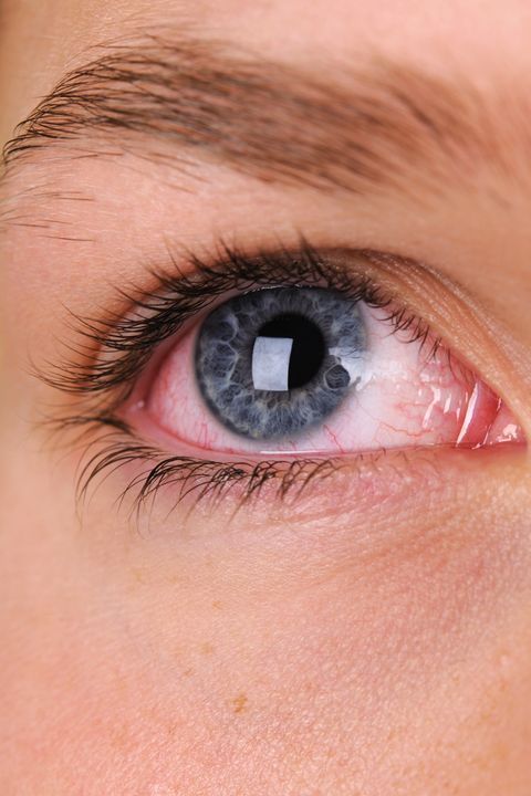 What Your Eyes Say About Your Health - Why Do I Have Red Eyes?