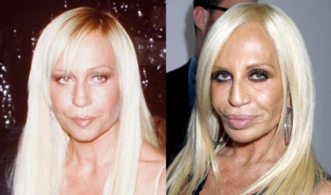 54eab1433fca1_-_02-botch-plastic-surgeries-donatella-versace-lifestyle-1.jpg