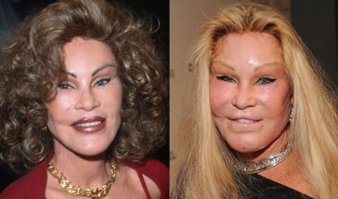 Image of celebrities with bad plastic surgery