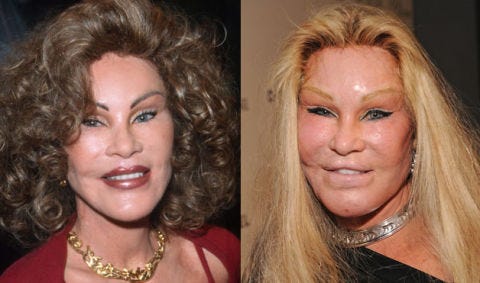 Image of celebrities with bad plastic surgery