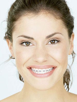 braces cheapest