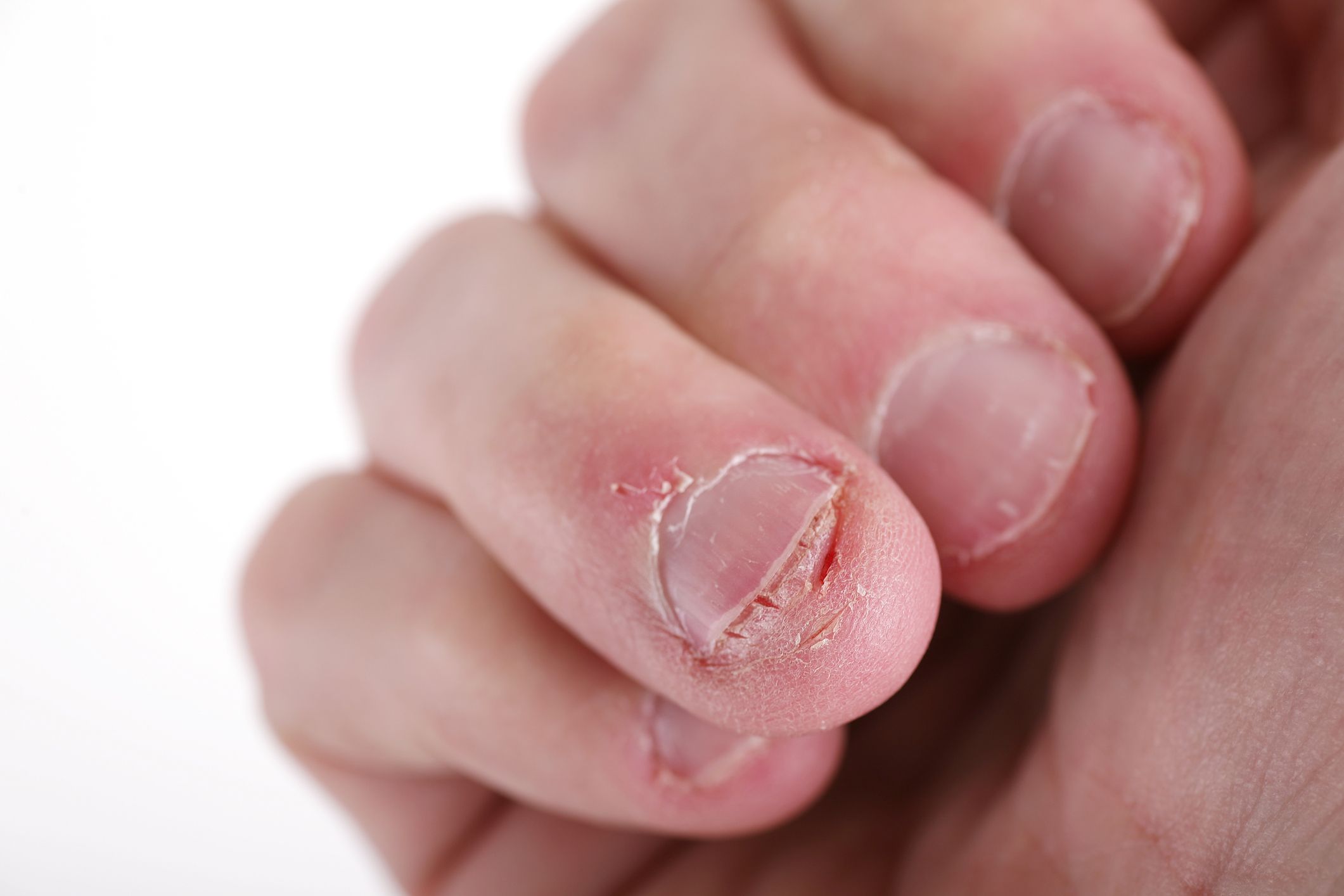 Nail Biting Infection: What Is It, Causes, and Treatment